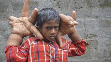 Imagem Indiano tem mãos gigantes de 33 centímetros e 16 quilos
