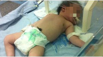 Imagem Famigerada Saúde Pública: bebê em estado grave luta pela vida na fila de espera