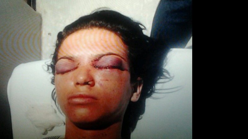 Imagem Ex-companheiro fura os olhos de mulher após tortura