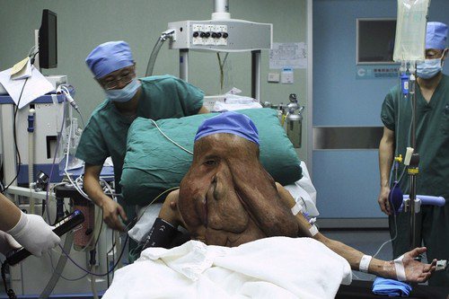 Imagem “Homem elefante” retira tumor de 15 quilos do rosto