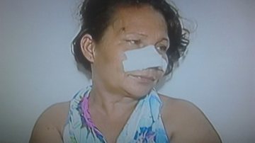 Imagem Ciúmes: mulher tem parte do nariz arrancado com mordida