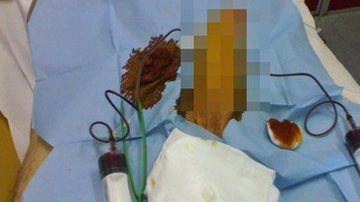 Imagem Camamu: homem dá entrada em hospital após 72 horas com pênis ereto